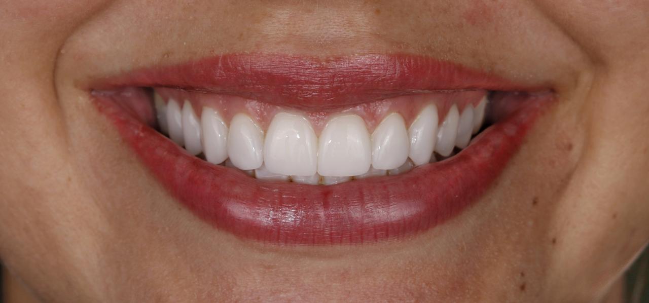 Lentes de Contato Dental